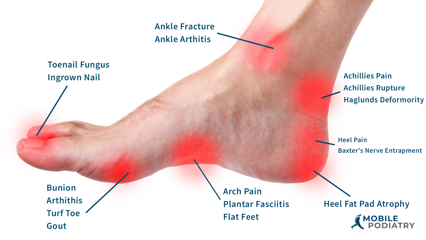 Diabetic foot care