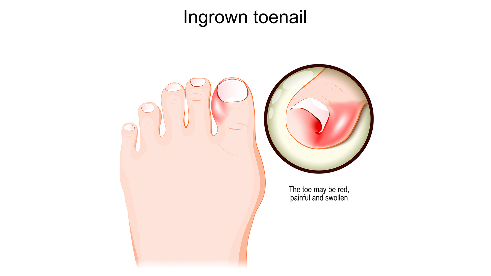 Ingrown toenail treatment